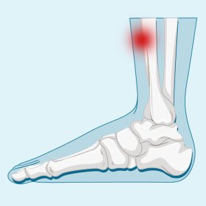 periostitis tibial